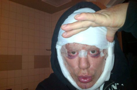 Микки Рурк стал еще одной жертвой пластической операции