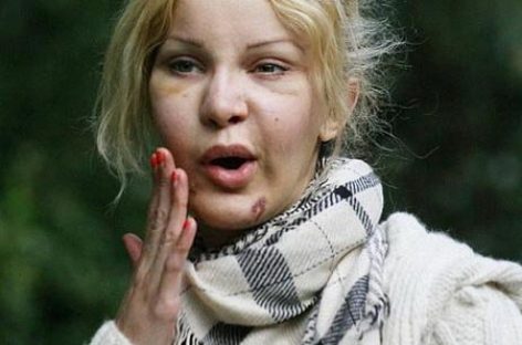 Звезды шоу-бизнеса рассказали о неудачных пластических операциях